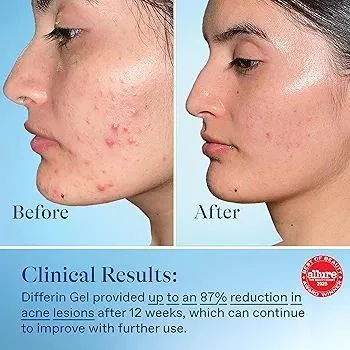 Differin Acne Treatment Gel