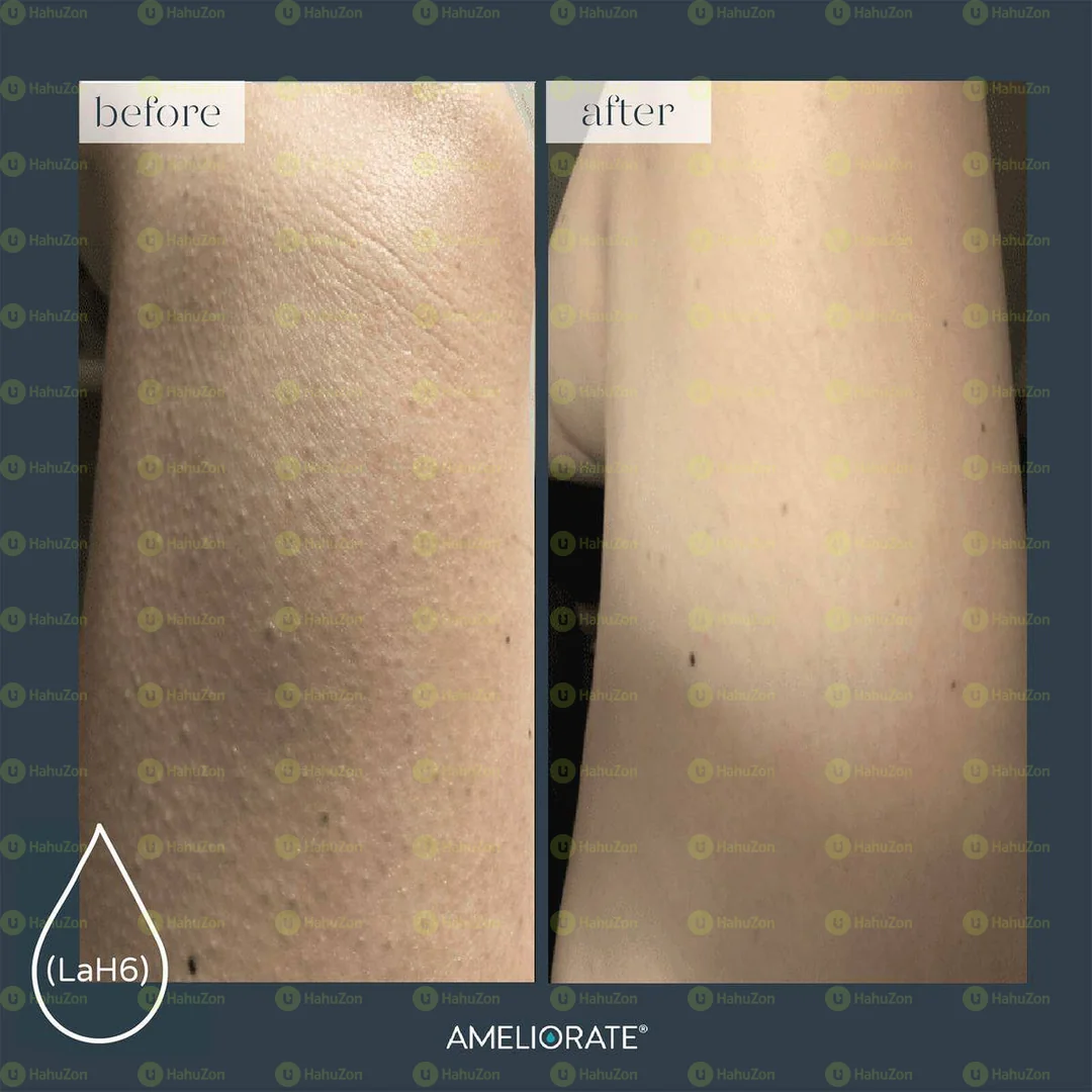 Amlactin Daily Moisturizing Lotion