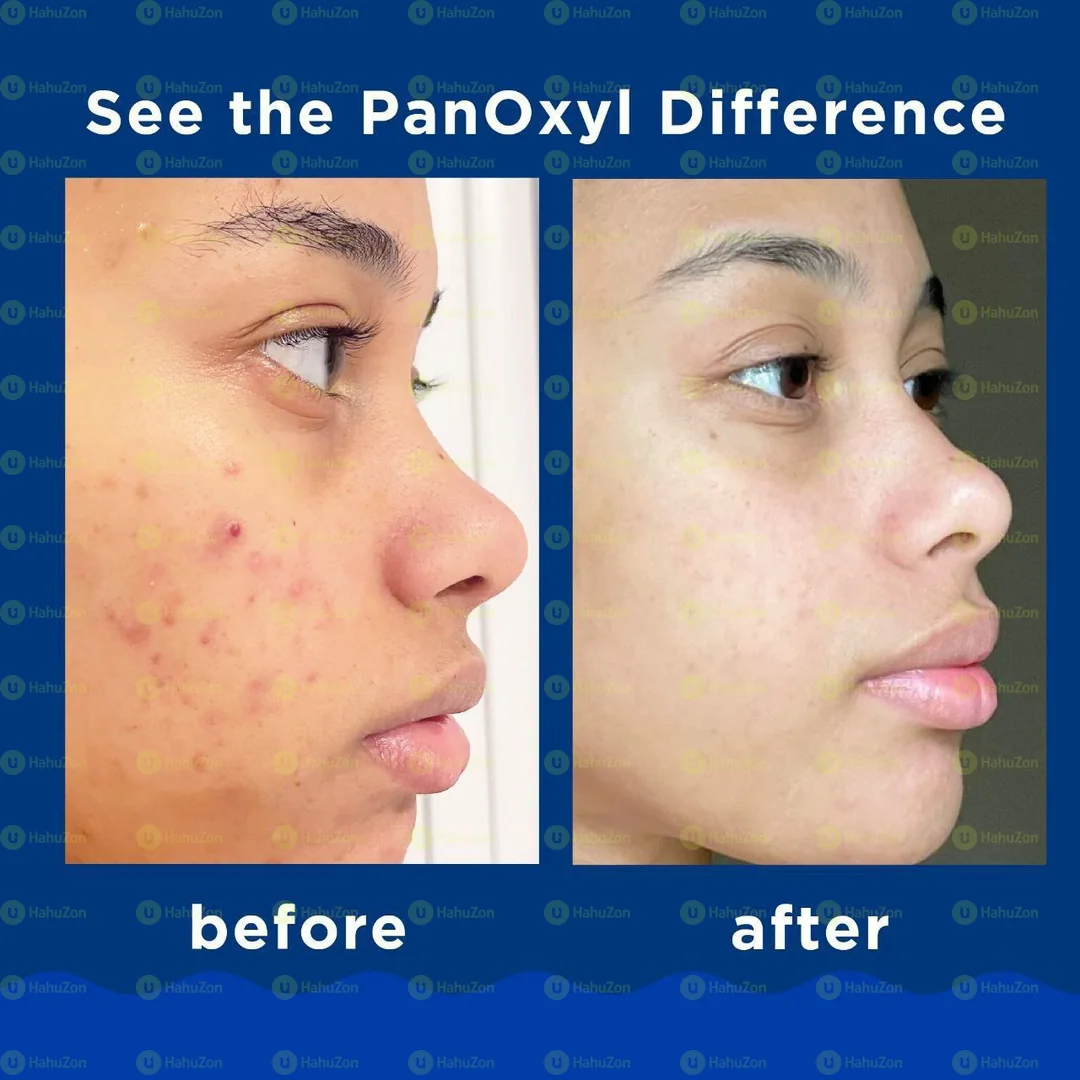 PanOxyl Acne Foaming Wash Benzoyl Peroxide