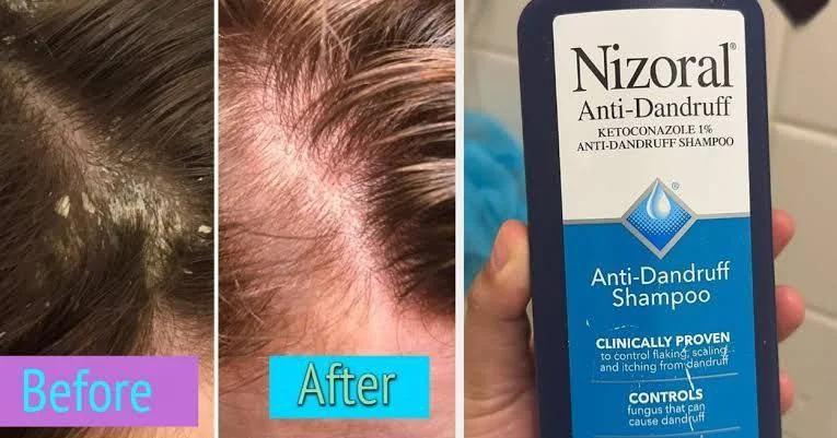 Nizoral Shampoo Ketoconazole 1%